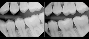 Bitewing Dental X-Ray