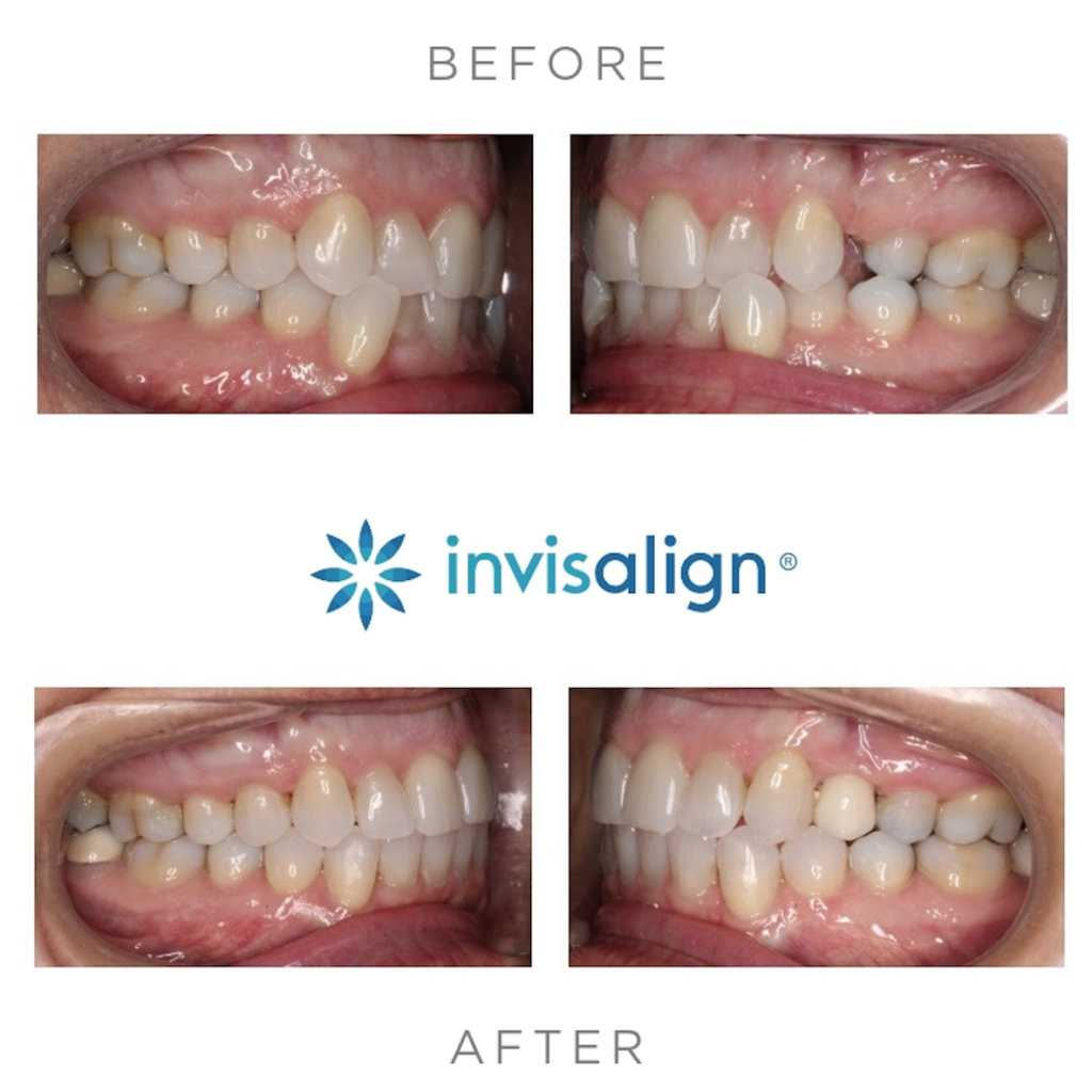 Before & After photos of Invisalign Treatment