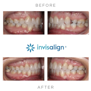 Antes y Después del Tratamiento con Invisalign
