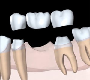 Dental Bridge Diagram
