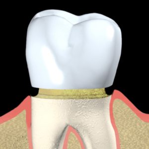Diagram of Dental Crown